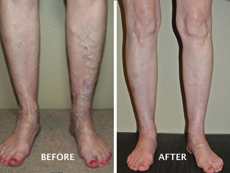 Before After Varicose Veins