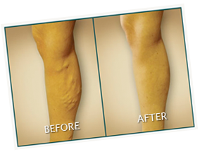 Before After Vein Therapy