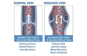 Normal Vs Diseased Vein