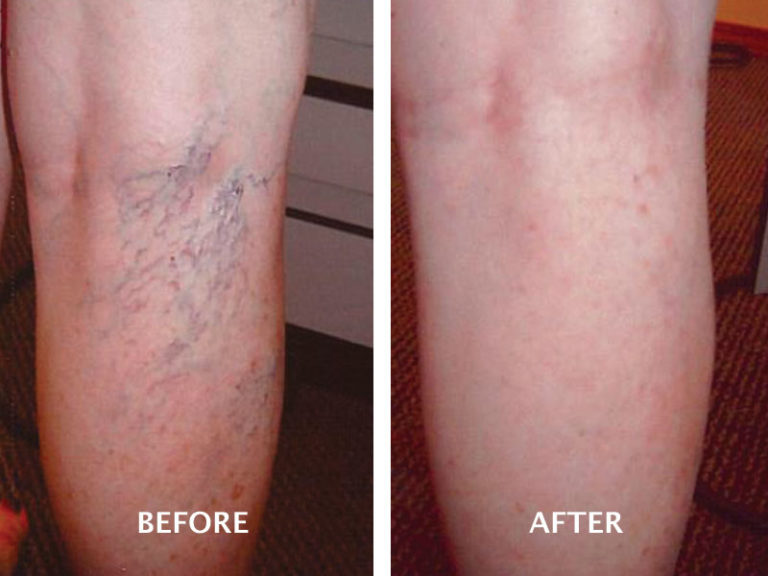 Spider Veins Archives - Page 2 of 2 - Advanced Vein Therapy