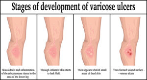 Stages Of Varicose Ulcers