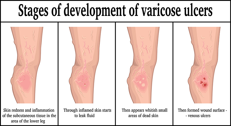 What Are Venous Leg Ulcers Advanced Vein Therapy
