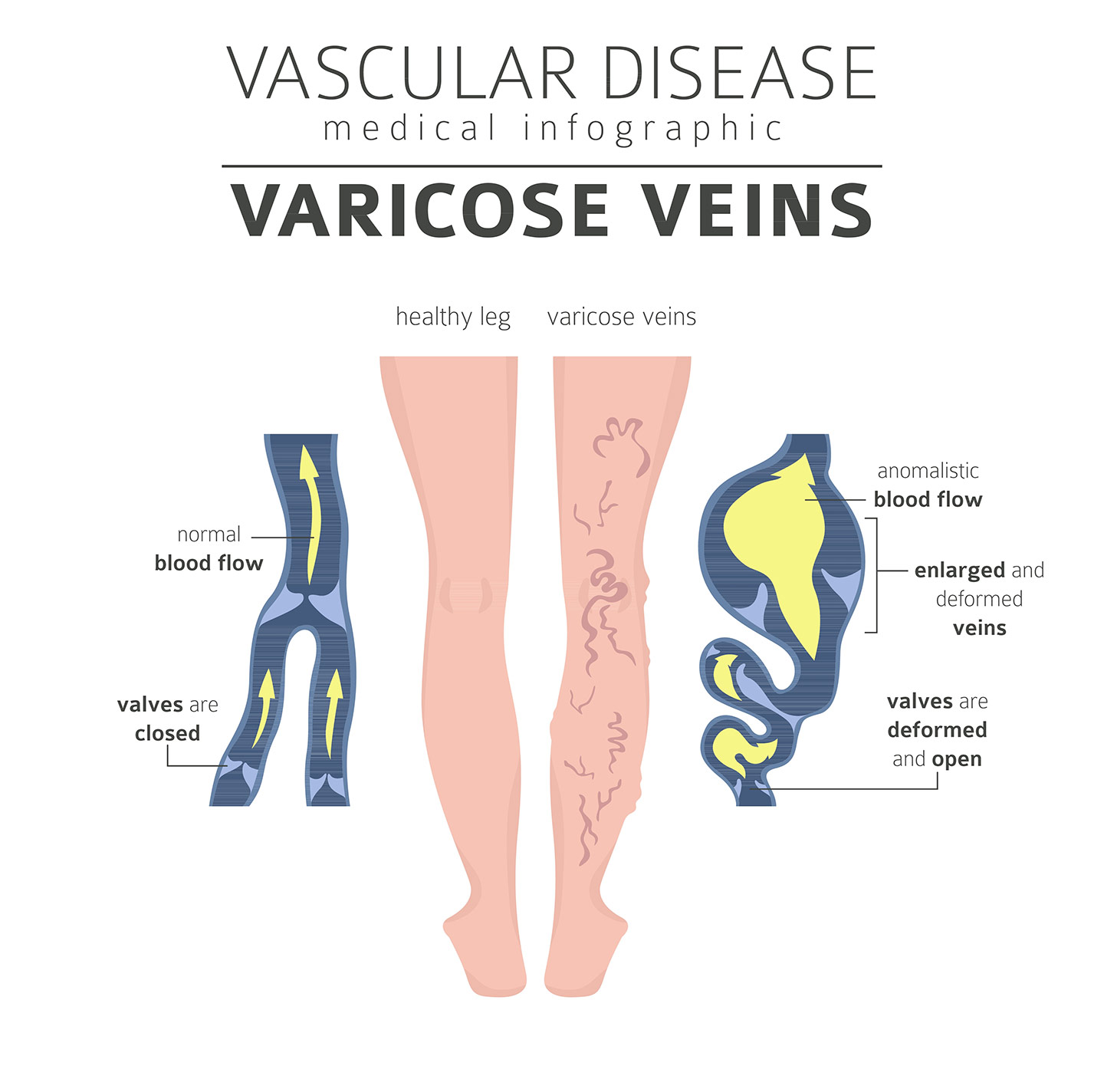 Vascular Disease Infographic