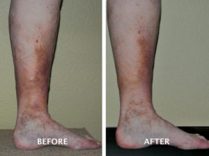 Vj Venous Ulceration